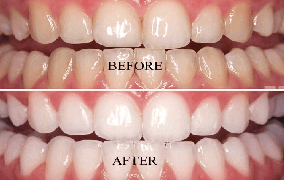 Teeth Whitening Services | Tower House Dental Clinic